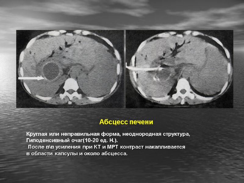 Абсцесс печени  Круглая или неправильная форма, неоднородная структура,  Гиподенсивный очаг(10-20 ед. Н.).